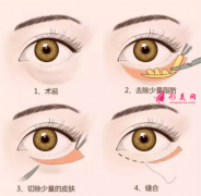手術(shù)祛眼袋會(huì)損傷眼睛嗎？
