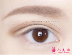 切開雙眼皮術(shù)后凹陷還能修復(fù)嗎？