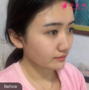 上海九院余東顴骨整形案例術(shù)后恢復(fù)日記，V臉來啦！