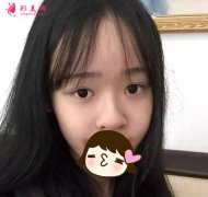 煙臺鵬愛整形醫(yī)院隆鼻怎么樣？術(shù)后效果分享