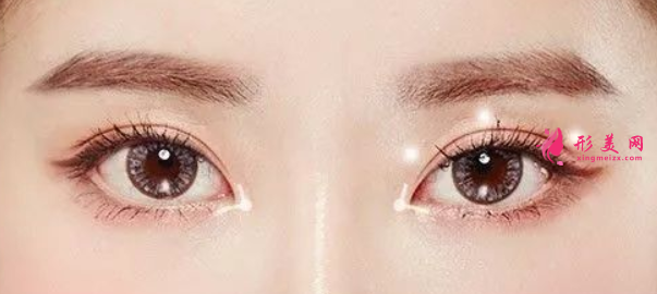 雙眼皮手術(shù)可能出現(xiàn)的后遺癥