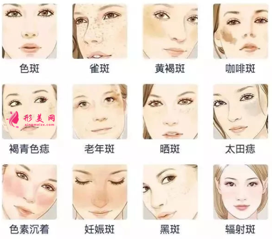 激光祛斑后會不會有結(jié)痂