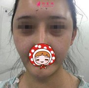 鄭州集美劉德輝祛眼袋+自體脂肪填充案例 面部年輕一步逆襲