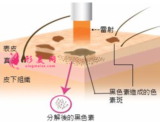 激光祛斑后多少天可以洗臉