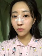 廣東韓妃李光琴做鼻綜合，效果好不好一眼就知道