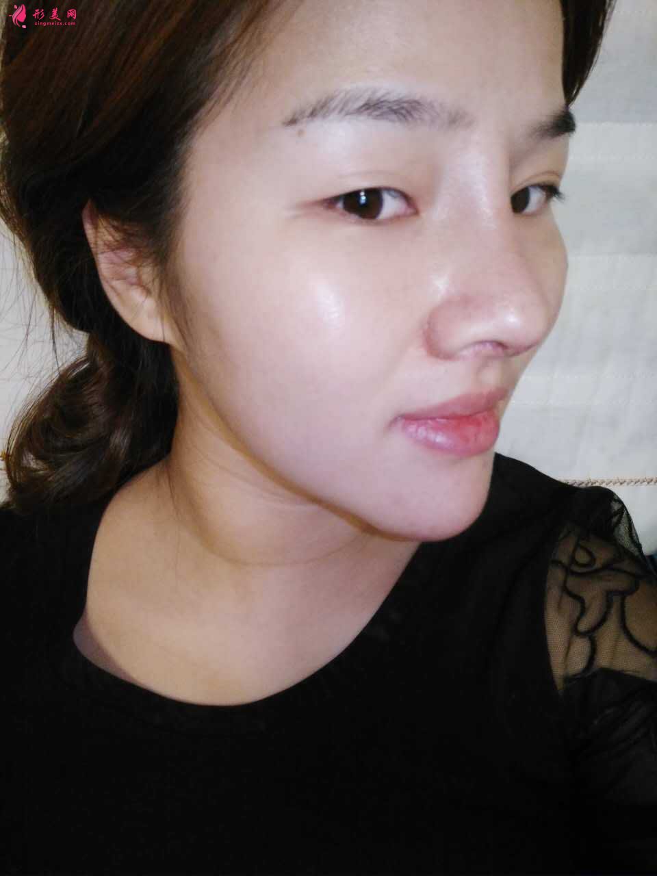 整形后