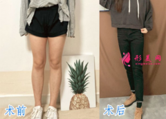 寧波靜港祝海新大腿吸脂怎么樣？術(shù)后案例分享吸脂全過程