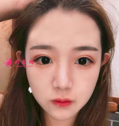 廈門華美于璇切開雙眼皮案例 廈門華美于璇切開雙眼皮案例