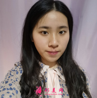 天姿醫(yī)療美容醫(yī)院李烈面吸案例