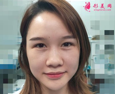 武漢韓辰醫(yī)療美容醫(yī)院吳輝鼻部整形案例對(duì)比圖 武漢韓辰醫(yī)療美容鼻部多項(xiàng)案例