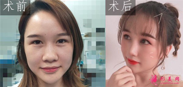 武漢韓辰醫(yī)療美容醫(yī)院吳輝鼻部整形案例對(duì)比圖 武漢韓辰醫(yī)療美容鼻部多項(xiàng)案例