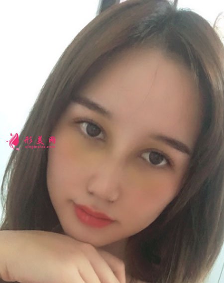 武漢韓辰醫(yī)療美容醫(yī)院吳輝鼻部整形案例對(duì)比圖 武漢韓辰醫(yī)療美容鼻部多項(xiàng)案例