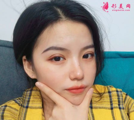 重慶美圣美邦醫(yī)療美容鄧剛雙眼皮案例對比圖 重慶美圣美邦醫(yī)療美容眼部多項案例