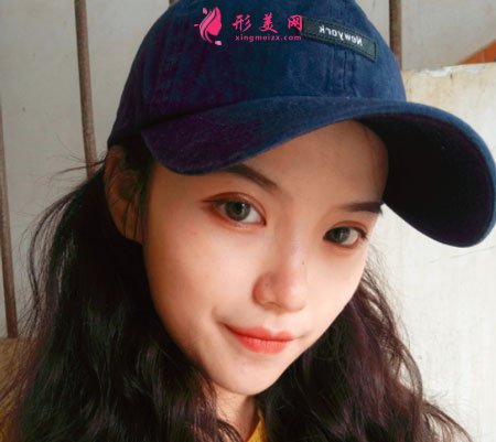 重慶美圣美邦醫(yī)療美容鄧剛雙眼皮案例對比圖 重慶美圣美邦醫(yī)療美容眼部多項案例