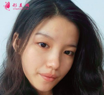 重慶美圣美邦醫(yī)療美容鄧剛雙眼皮案例對比圖 重慶美圣美邦醫(yī)療美容眼部多項案例
