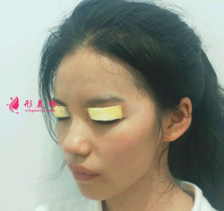重慶美圣美邦醫(yī)療美容鄧剛雙眼皮案例對比圖 重慶美圣美邦醫(yī)療美容眼部多項案例