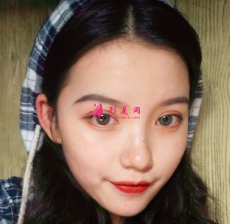 重慶美圣美邦醫(yī)療美容鄧剛雙眼皮案例對比圖 重慶美圣美邦醫(yī)療美容眼部多項案例