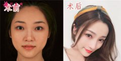 寧波珈禾整形專科醫(yī)院隆鼻效果怎么樣?案例|對比圖