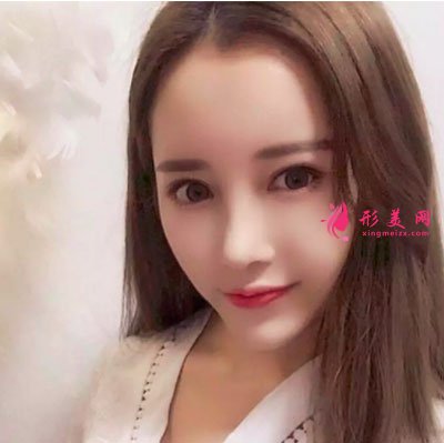 上海喜美醫(yī)療美容鼻部修復(fù)案例