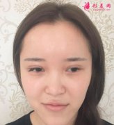 上海喜美王會勇鼻部修復(fù)怎么樣？案例_價格分享給你們