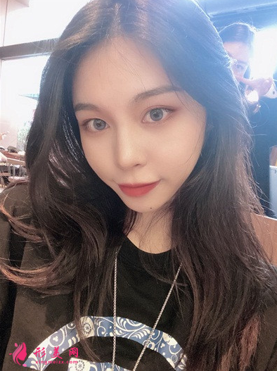 成都藝星周順波隆鼻效果怎么樣_假體硅膠隆鼻_真人案例