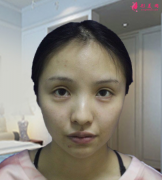 成都醫(yī)大整形醫(yī)院虞冬梅做鼻綜合怎么樣？
