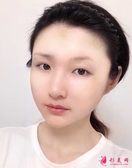 成都銅雀臺做自體脂肪面部填充多少錢？價格表？有沒有失敗案例