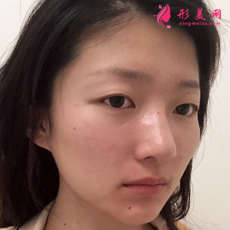 成都銅雀臺和華美相比做自體脂肪面部填充哪個醫(yī)生好？多少錢
