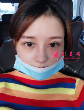 找成都成美整形醫(yī)院王立鵬做的自體軟骨隆鼻,價格_案例分享