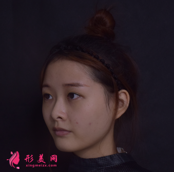 找成都成美整形醫(yī)院王立鵬做的自體軟骨隆鼻,價格_案例分享