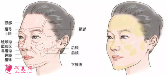 自體脂肪填充臉部需要多久恢復(fù)好