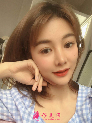 找成都銅雀臺雷剛做的三點式雙眼皮