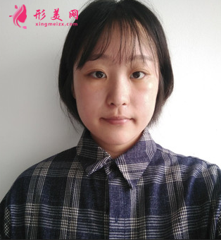 成都美萊做雙眼皮多少錢_埋線雙眼皮+外開(kāi)眼角怎么樣_案例效果