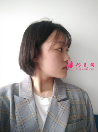 成都美萊做雙眼皮多少錢_埋線雙眼皮+外開(kāi)眼角怎么樣_案例效果