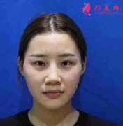 四川悅好醫(yī)學(xué)美容醫(yī)院雙眼皮怎么樣？給大家分享案例
