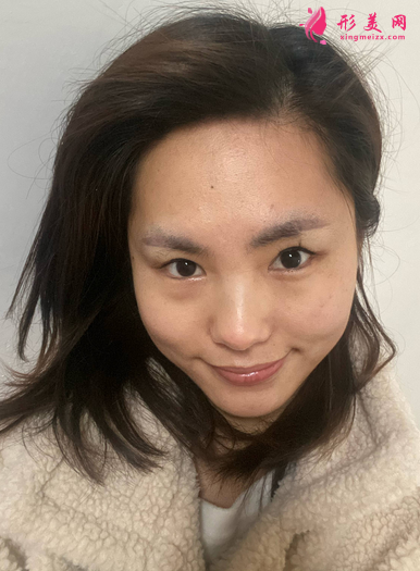 找成都美綻美整形美容醫(yī)院陳宇做的眼綜合，案例|價(jià)格分享給大家