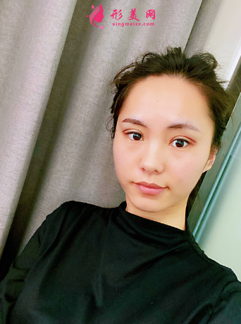 成都美綻美整形美容醫(yī)院陳宇做的眼綜合