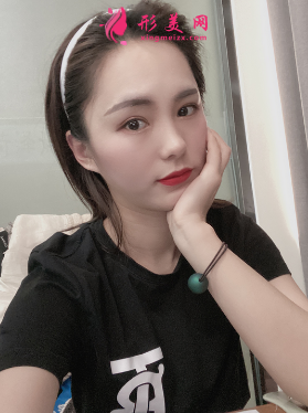 成都美綻美整形美容醫(yī)院陳宇做的眼綜合