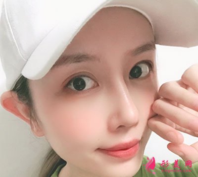 成都菲格隆鼻手術案例