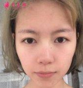 北京八大處靳小雷隆鼻案例分享，術(shù)后效果真實(shí)！