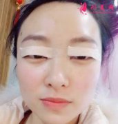 上海九院雙眼皮怎么樣？手術(shù)案例及價格表一覽