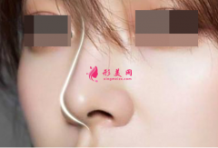 假體隆鼻手術會影響呼吸嗎？
