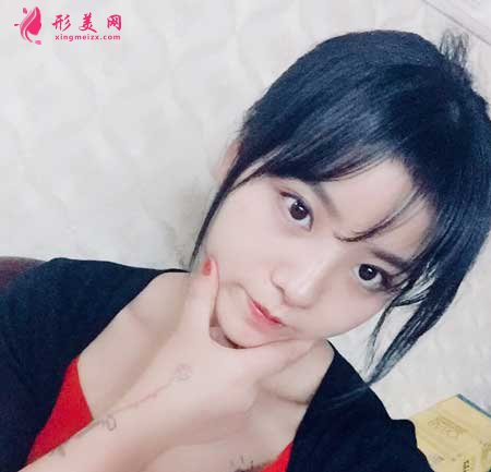 鼻綜合整形術(shù)后15天