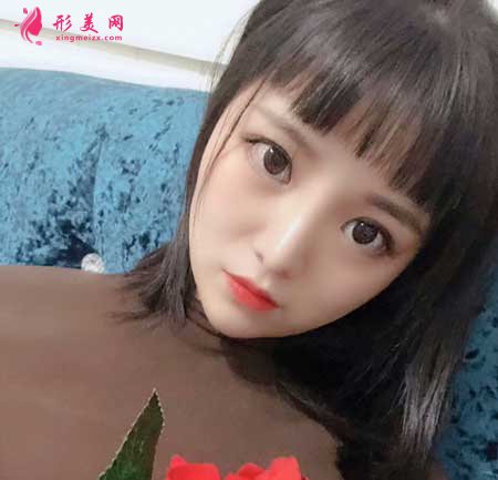 鼻綜合整形術(shù)后2個月