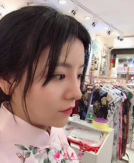 鼻綜合整形術(shù)后25天