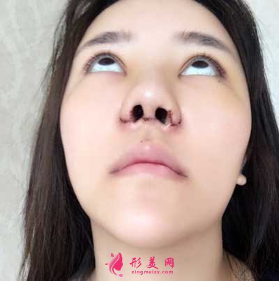 鼻綜合整形術(shù)后第3天