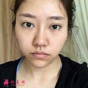 成都軍大做的鼻綜合整形，我也能輕松擁有小翹鼻了