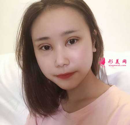 眼綜合整形術(shù)后12天