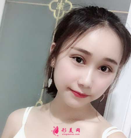 眼綜合整形術(shù)后20天