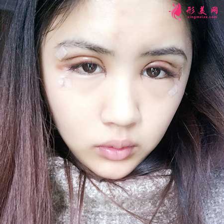 全切雙眼皮手術(shù)前